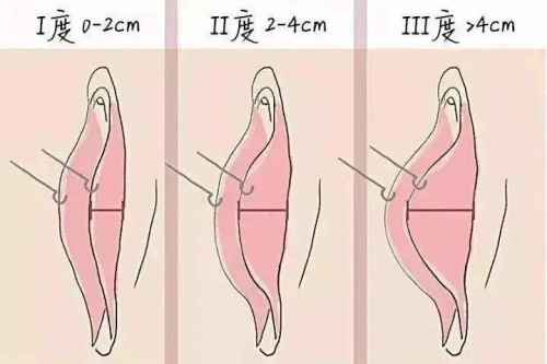 小阴唇肥大程度等级