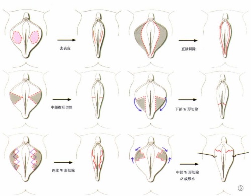 小阴唇手术方式