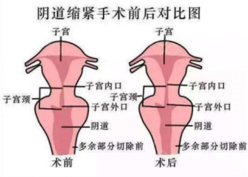 阴道紧缩手术前后对比图