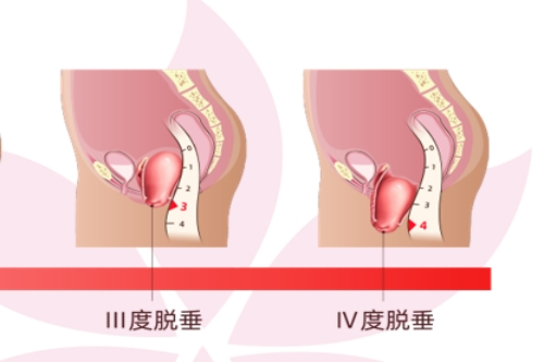 中重度子宫脱垂