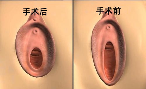 缩阴手术前后
