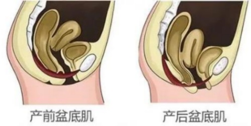 产前后盆底肌