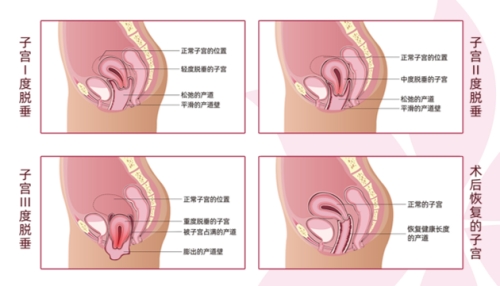 后方膣圆盖术