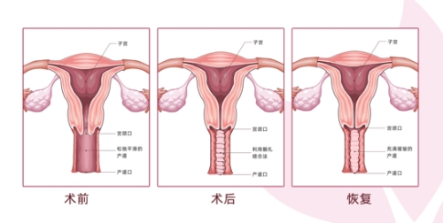 褶皱成形术的结果