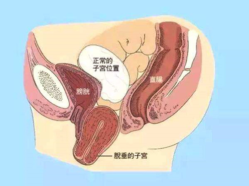 子宫下垂会引发其他妇科疾病
