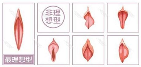 大阴唇下垂
