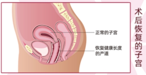 后方膣圆盖术后的样子