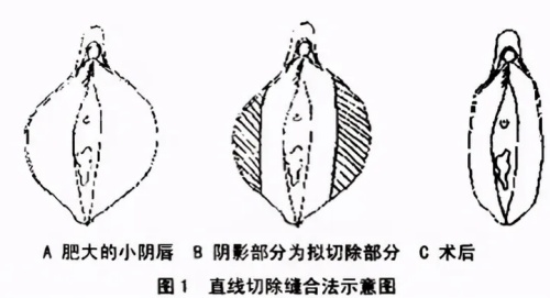 割小阴唇