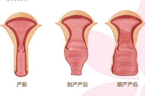 阴道紧缩手术