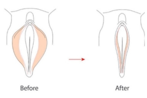 大小阴唇整形