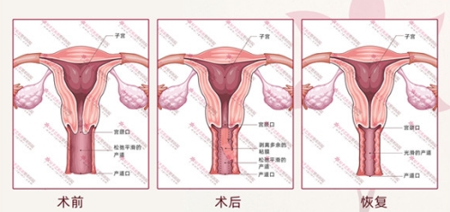 褶皱成形术