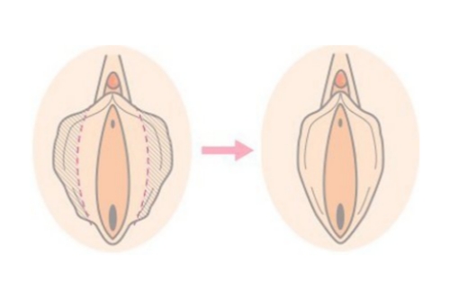 大阴唇整形手术