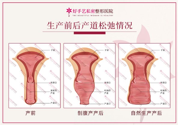 阴道前壁松弛